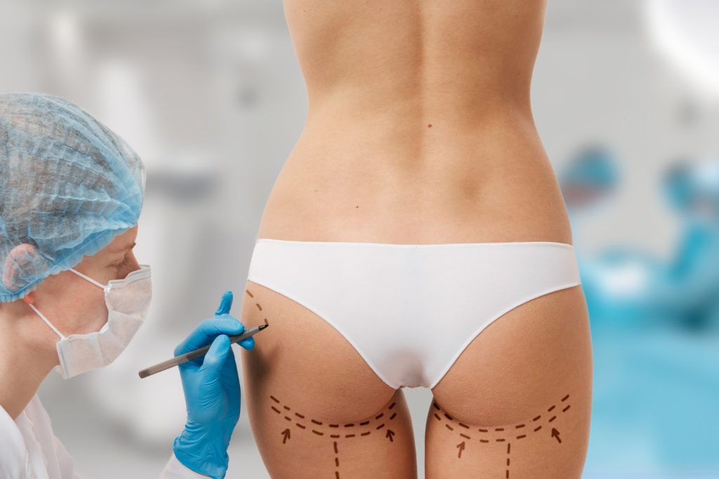Non-Surgical BBL