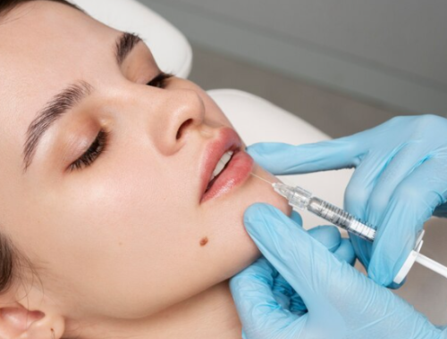 Dermal Fillers
