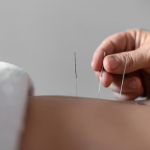 Acupuncture