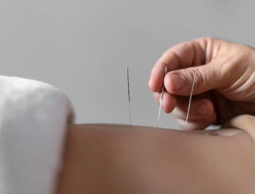 Acupuncture