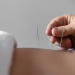 Acupuncture